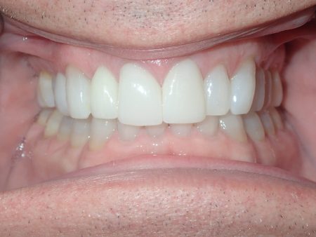 After Implant CN and Veneer