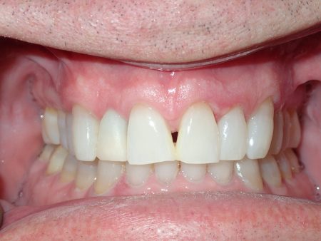 Before Implant CN and Veneer